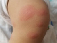 宝宝被蚊子咬了红肿特别大怎么办